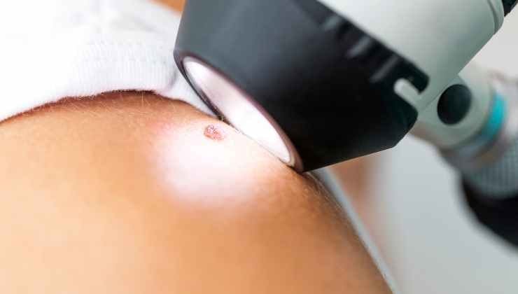 Melanoma come riconoscere i sintomi meno noti